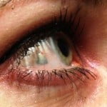 La última moda estética: implantarse en el ojo una joya