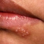 Luce unos labios espectaculares curando los herpes con trucos caseros
