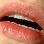 ¿Tienes un herpes en el labio? Aprende los mejores trucos para hacerlo desaparecer