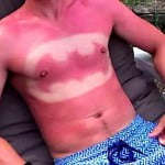 Sunburn Art, una moda de belleza muy peligrosa